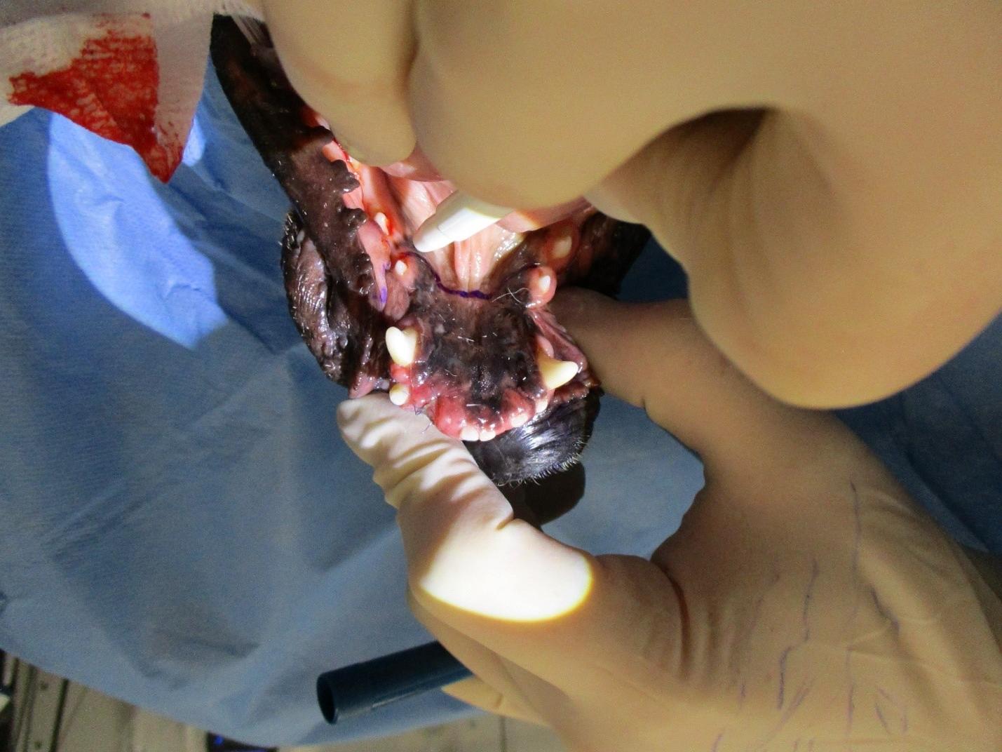 Metal crown after placement on a previously fractured maxillary fourth premolar, which also received root canal treatment.